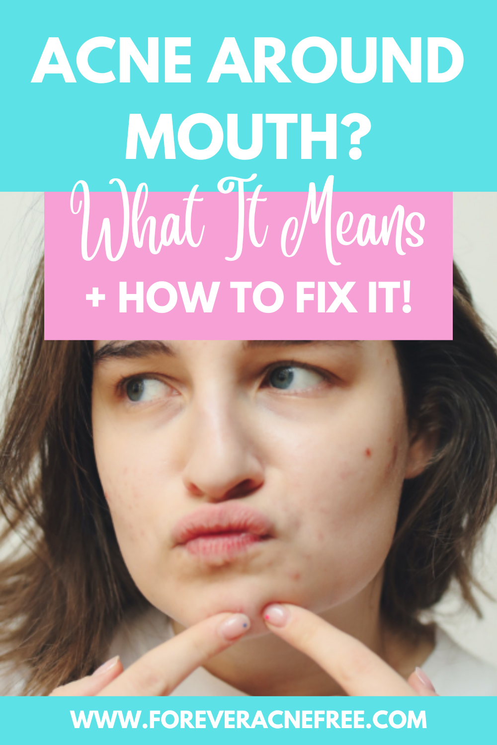 Acne Around Mouth? What It Means And How To Fix It! - Forever Acne Free