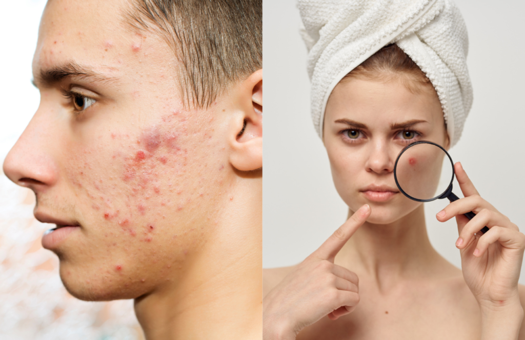 What Is Acne?: A Comprehensive Guide - Forever Acne Free