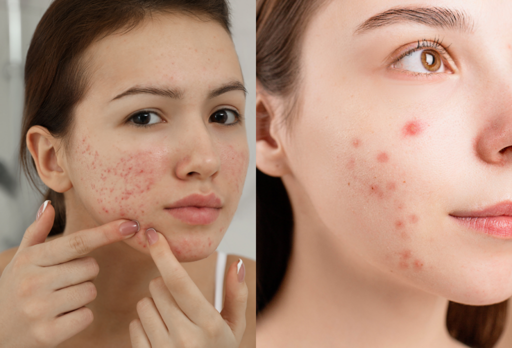 What Is Acne?: A Comprehensive Guide - Forever Acne Free