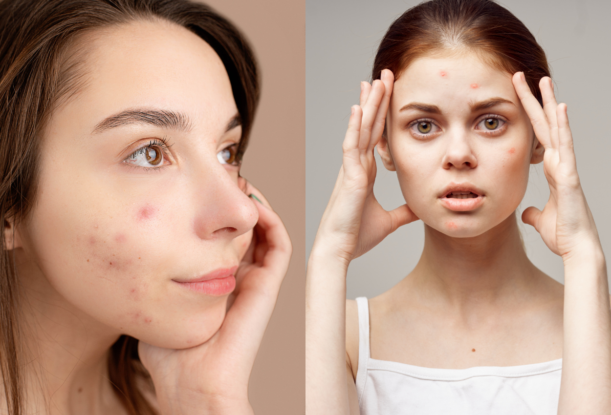 What Is Acne?: A Comprehensive Guide - Forever Acne Free